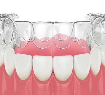 Illustration of Invisalign aligner being placed on teeth