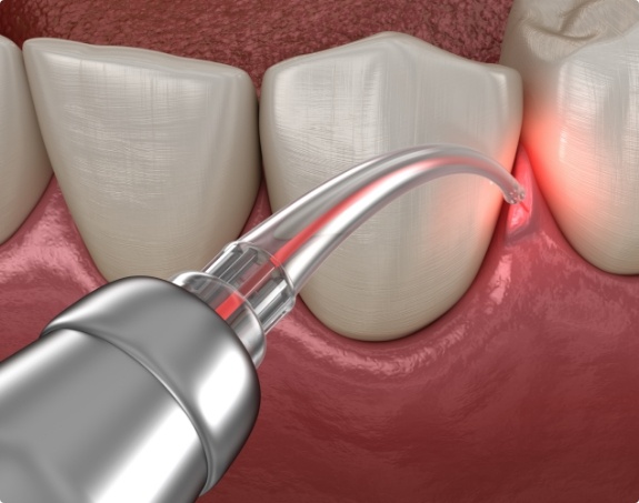 Animated smile during laser gum disease treatment