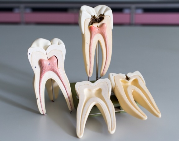 Model healthy tooth compared with tooth in need of root canal treatment