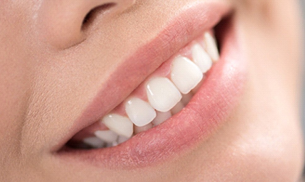 Close-up of a beautiful smile after teeth whitening in Morgan Hill, CA