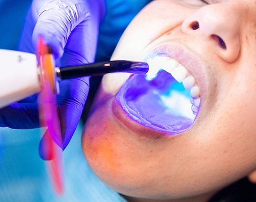 a person having a tooth bonded