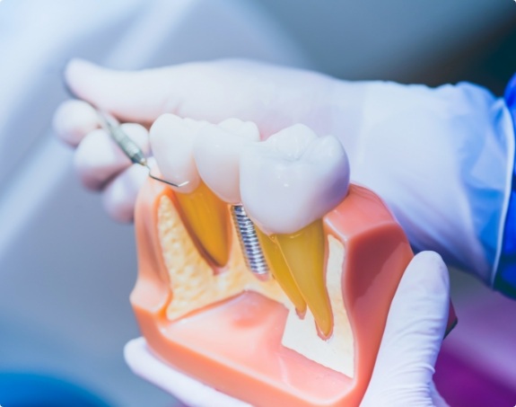 Dentist holding model comparing dental implant supported replacement tooth to natural tooth