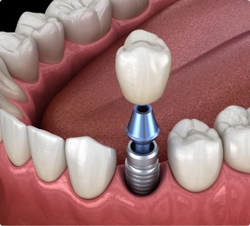 Animated smile during dental implant supported dental crown placement