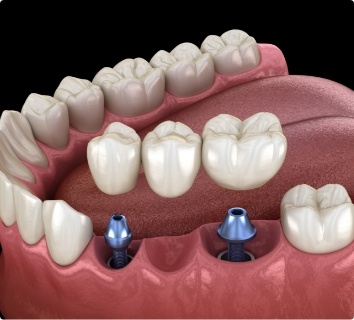 Animated smile during dental implant supported fixed bridge placement