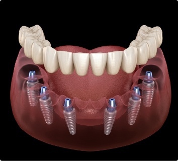 Animated smile during dental implant denture placement