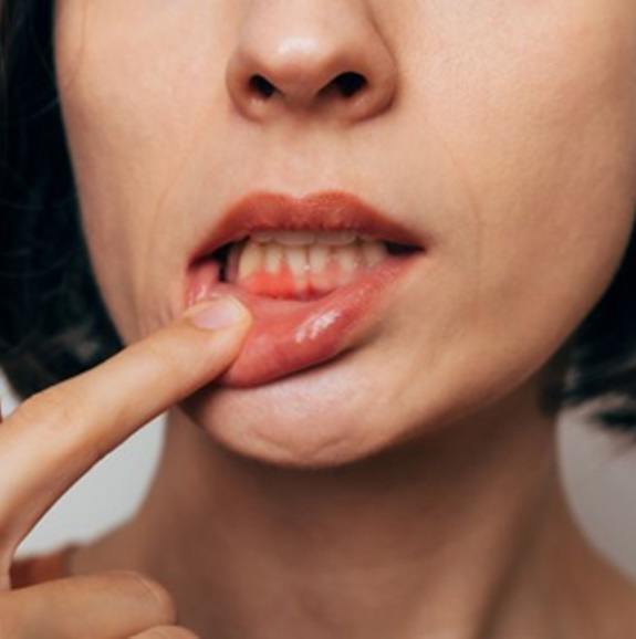 Woman pulling her lip back to reveal red gums