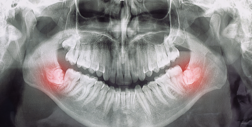 X-ray of wisdom teeth