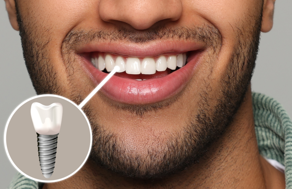 Close up of man's mouth with dental implant